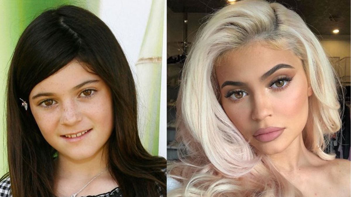 Kylie Jenner Before And After Plastic Surgery